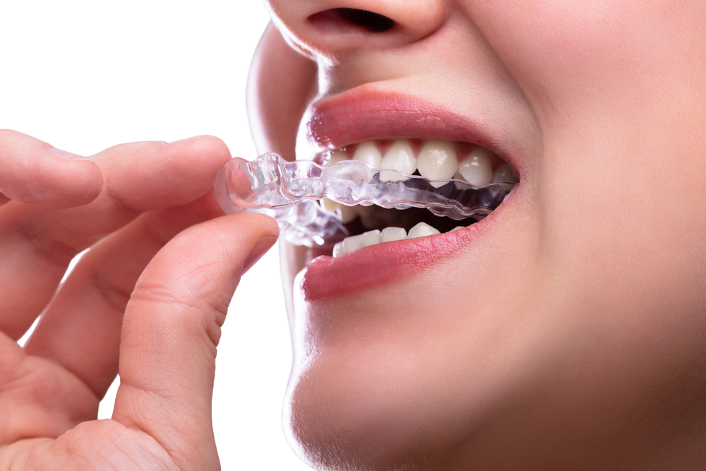 Clear Aligners