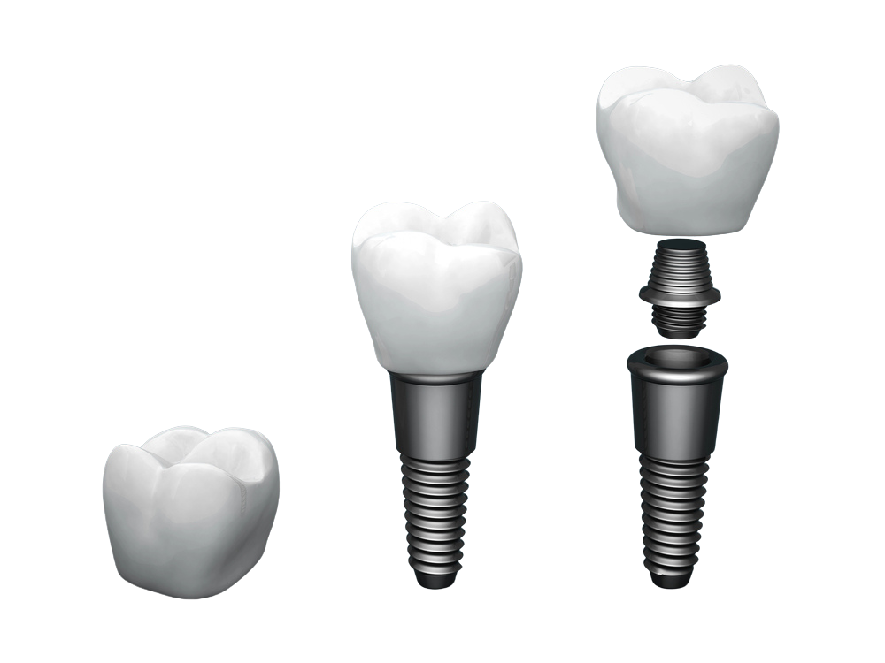 Dental Implants