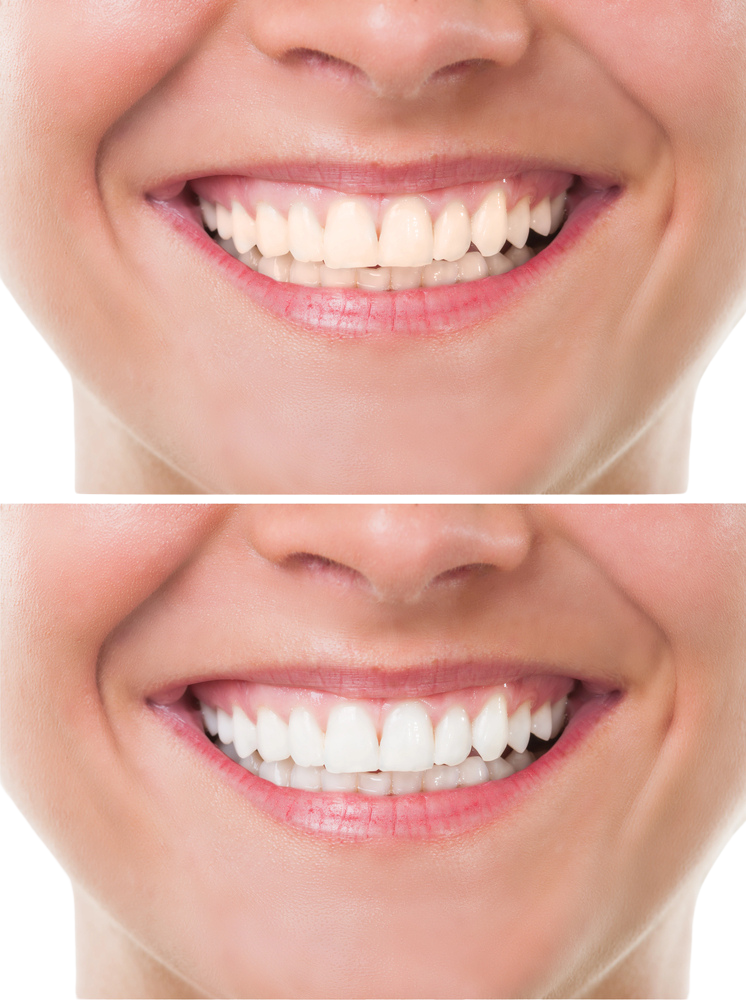 Teeth Whitening